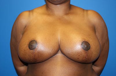 Breast Reduction Before & After Gallery - Patient 835244 - Image 2