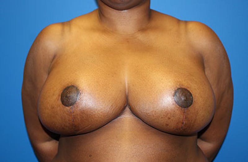 Breast Reduction Before & After Gallery - Patient 835244 - Image 2