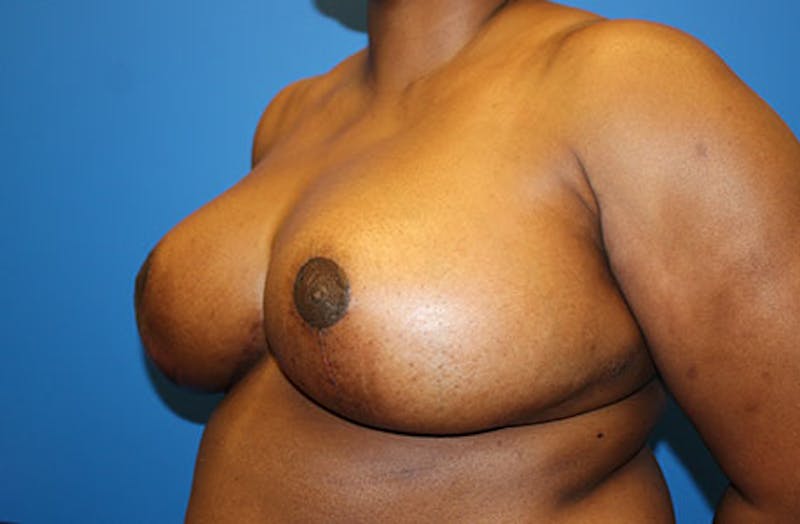 Breast Reduction Before & After Gallery - Patient 835244 - Image 4