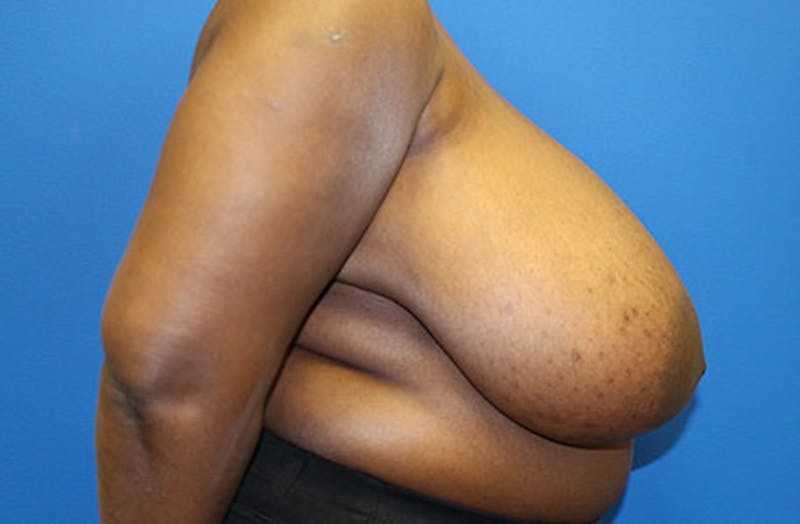 Breast Reduction Before & After Gallery - Patient 835244 - Image 5
