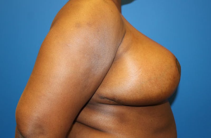 Breast Reduction Before & After Gallery - Patient 835244 - Image 6