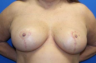 Breast Reduction Before & After Gallery - Patient 237434 - Image 2