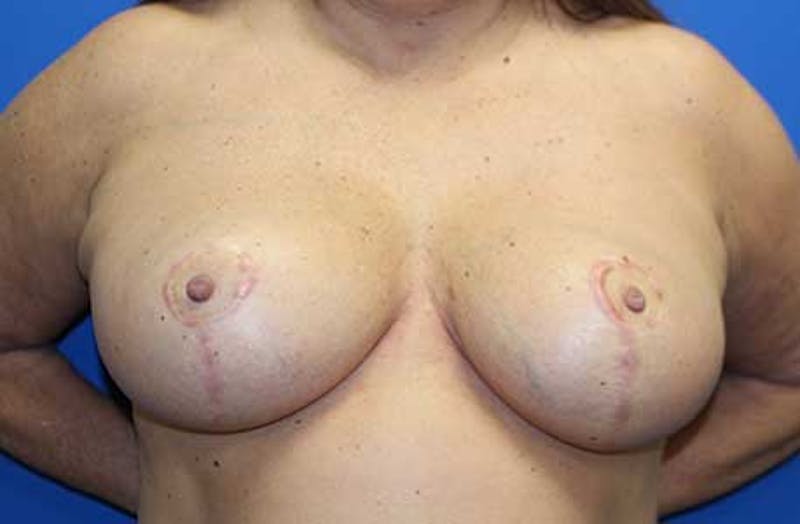 Breast Reduction Before & After Gallery - Patient 237434 - Image 2