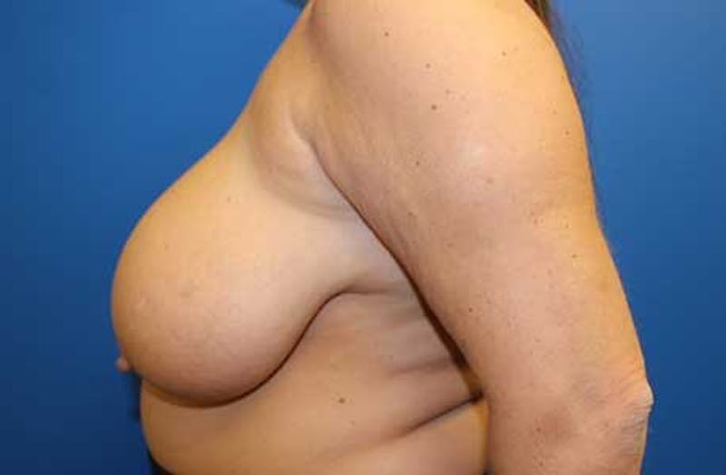 Breast Reduction Before & After Gallery - Patient 237434 - Image 5