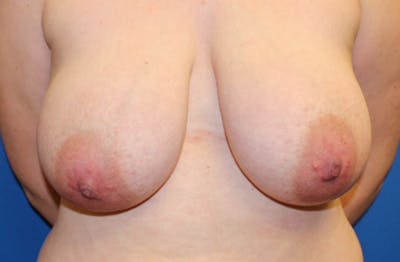 Breast Reduction Before & After Gallery - Patient 383791 - Image 1