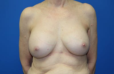 Breast Implant Removal Before & After Gallery - Patient 995367 - Image 1