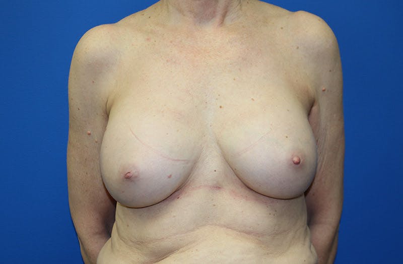 Breast Implant Removal Before & After Gallery - Patient 995367 - Image 1