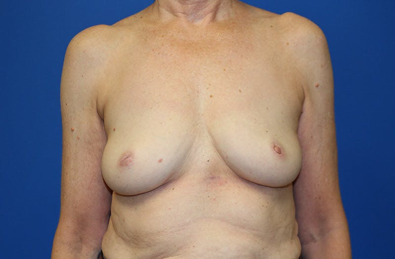 Breast Implant Removal Before & After Gallery - Patient 995367 - Image 2