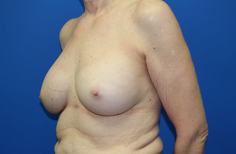 Breast Implant Removal Before & After Gallery - Patient 995367 - Image 3