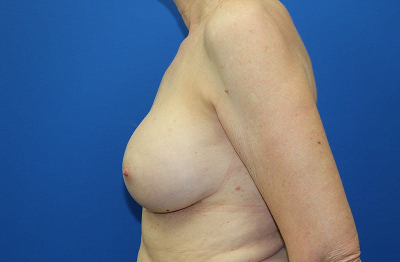 Breast Implant Removal Before & After Gallery - Patient 995367 - Image 5