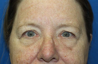 Brow Lift Before & After Gallery - Patient 289031 - Image 1