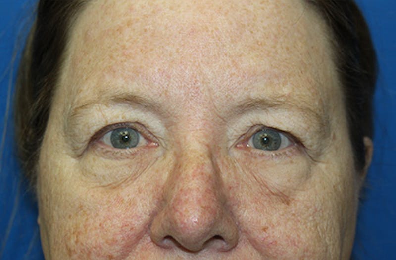 Brow Lift Before & After Gallery - Patient 289031 - Image 1