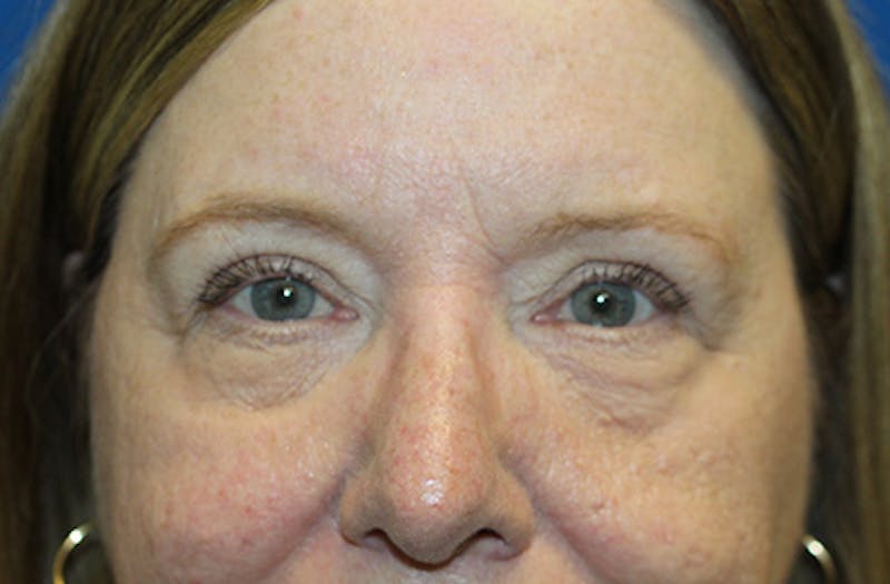 Brow Lift Before & After Gallery - Patient 289031 - Image 2