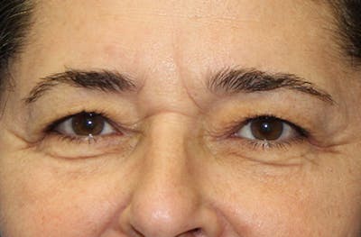 Brow Lift Before & After Gallery - Patient 411370 - Image 1
