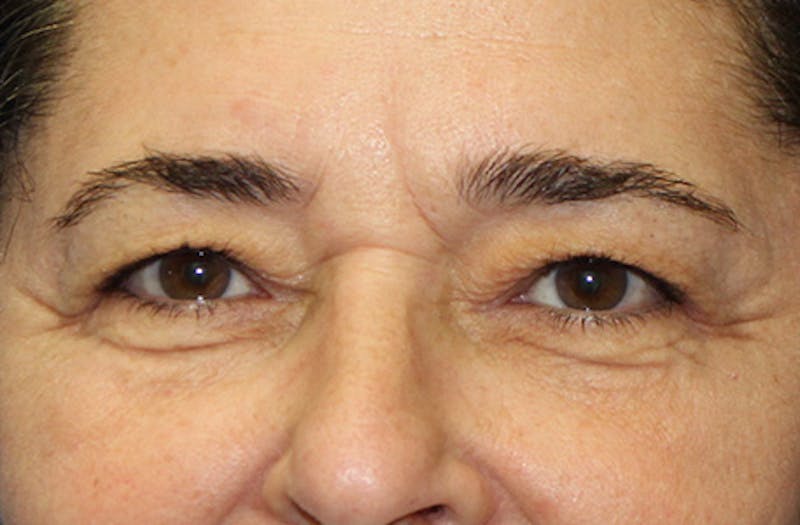 Upper & Lower Eyelid Surgery Before & After Gallery - Patient 179642 - Image 1