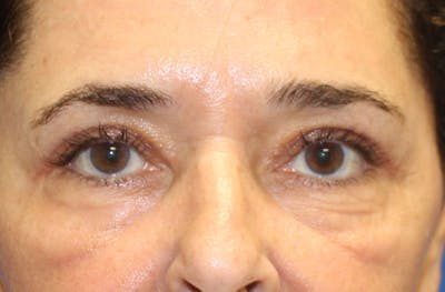 Brow Lift Before & After Gallery - Patient 411370 - Image 2