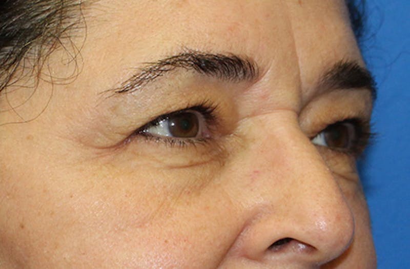 Upper & Lower Eyelid Surgery Before & After Gallery - Patient 179642 - Image 3