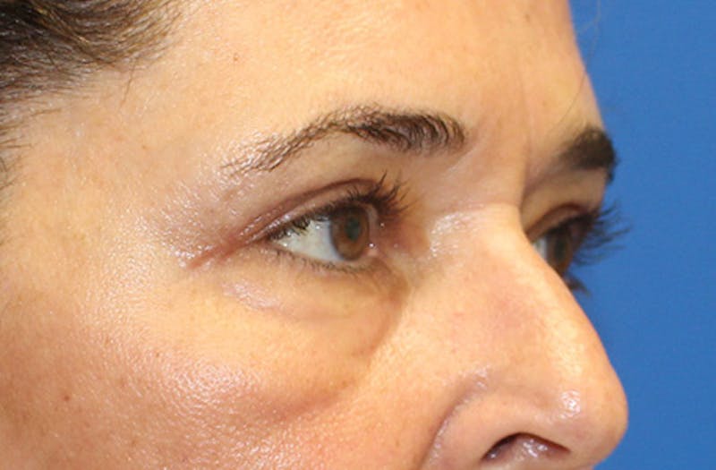 Upper & Lower Eyelid Surgery Before & After Gallery - Patient 179642 - Image 4