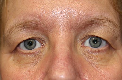 Brow Lift Before & After Gallery - Patient 302267 - Image 1