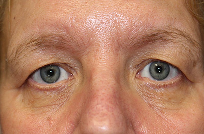 Brow Lift Before & After Gallery - Patient 302267 - Image 1