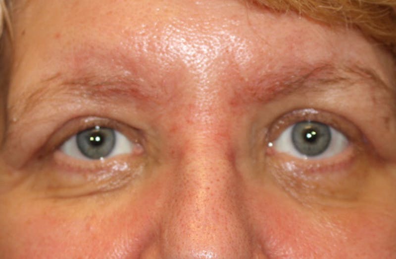 Brow Lift Before & After Gallery - Patient 302267 - Image 2