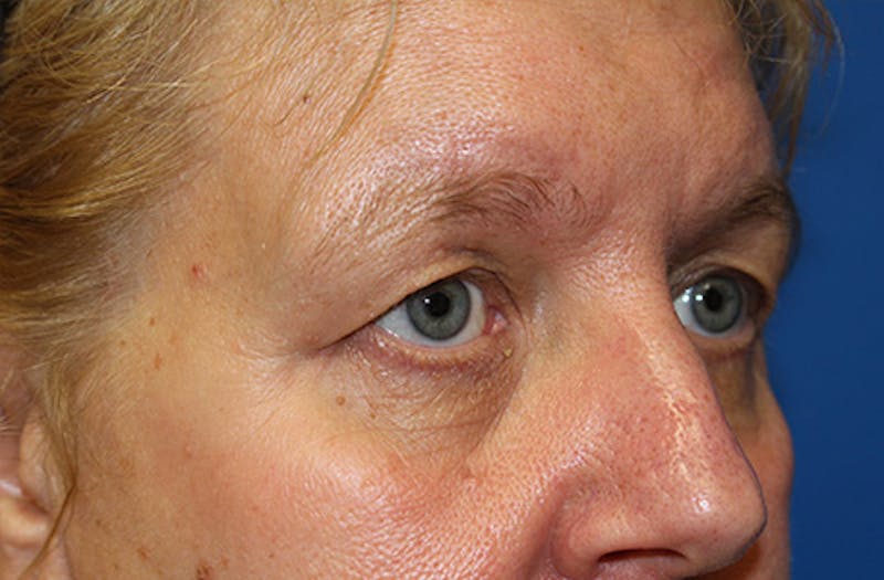 Brow Lift Before & After Gallery - Patient 302267 - Image 3
