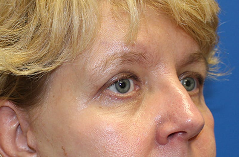 Brow Lift Before & After Gallery - Patient 302267 - Image 4