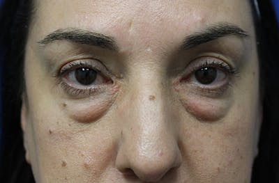 Lower Eyelid Surgery Before & After Gallery - Patient 202495 - Image 1
