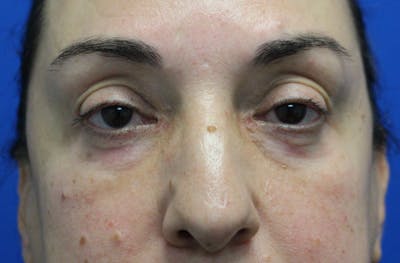 Lower Eyelid Surgery Before & After Gallery - Patient 202495 - Image 2