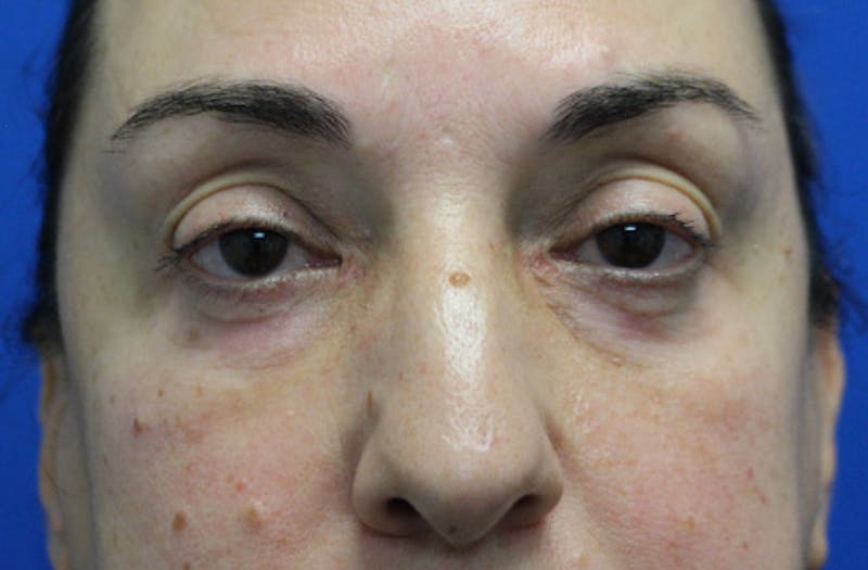 Lower Eyelid Surgery Before & After Gallery - Patient 202495 - Image 2