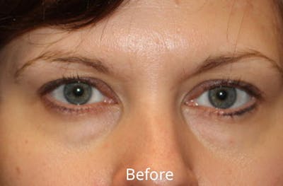 Upper Eyelid Surgery Before & After Gallery - Patient 176051 - Image 1
