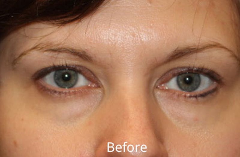 Upper Eyelid Surgery Before & After Gallery - Patient 176051 - Image 1