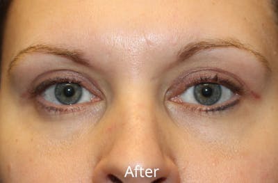 Upper Eyelid Surgery Before & After Gallery - Patient 176051 - Image 2