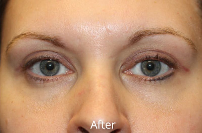 Upper Eyelid Surgery Before & After Gallery - Patient 176051 - Image 2