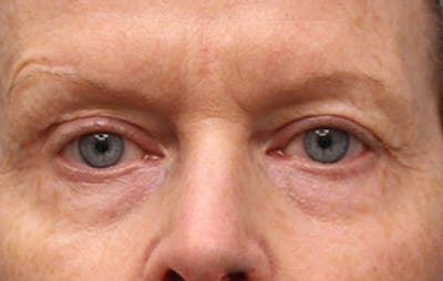 Upper Eyelid Surgery Before & After Gallery - Patient 188318 - Image 1