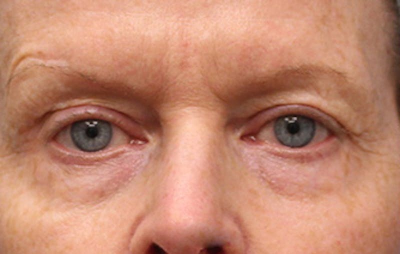 Upper & Lower Eyelid Surgery Before & After Gallery - Patient 123213 - Image 1