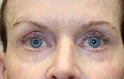 Upper Eyelid Surgery Before & After Gallery - Patient 188318 - Image 2