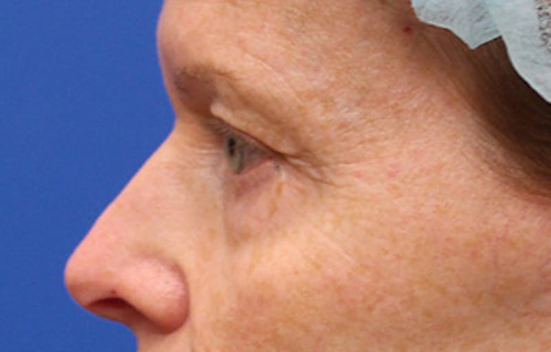 Upper & Lower Eyelid Surgery Before & After Gallery - Patient 123213 - Image 3