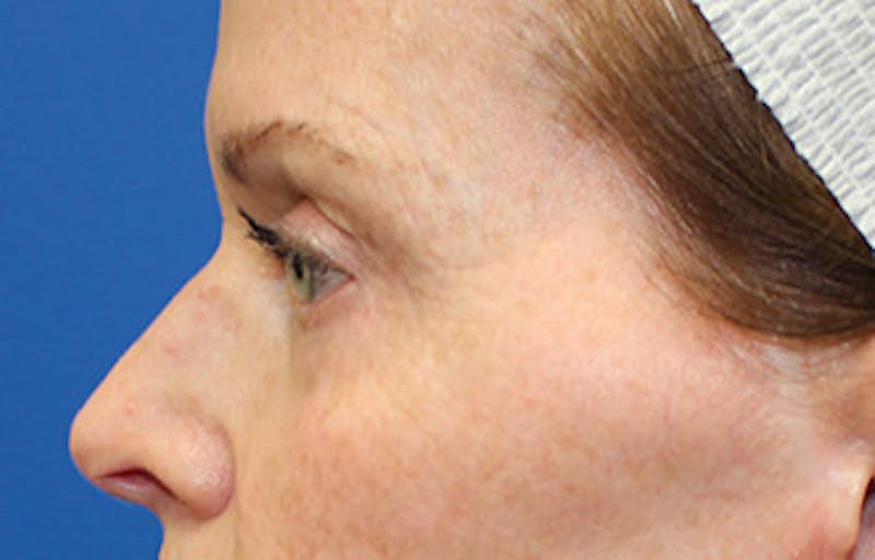 Upper & Lower Eyelid Surgery Before & After Gallery - Patient 123213 - Image 4