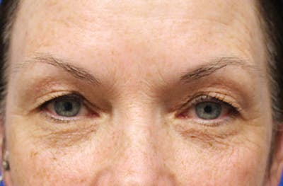 Upper Eyelid Surgery Before & After Gallery - Patient 413806 - Image 1