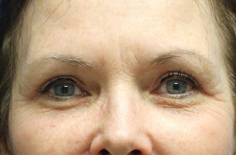 Upper Eyelid Surgery Before & After Gallery - Patient 413806 - Image 2