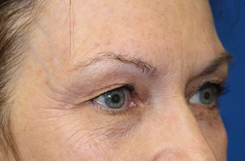 Upper Eyelid Surgery Before & After Gallery - Patient 413806 - Image 3
