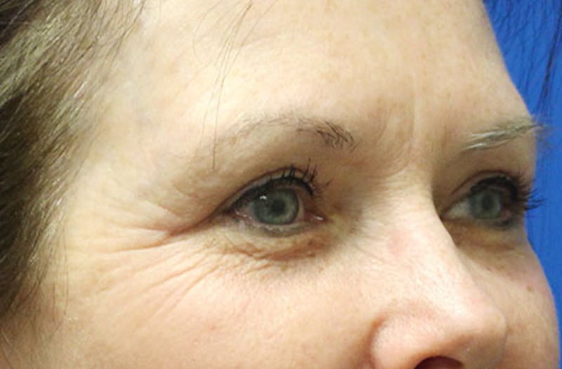 Upper Eyelid Surgery Before & After Gallery - Patient 413806 - Image 4