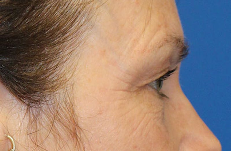 Upper Eyelid Surgery Before & After Gallery - Patient 413806 - Image 5