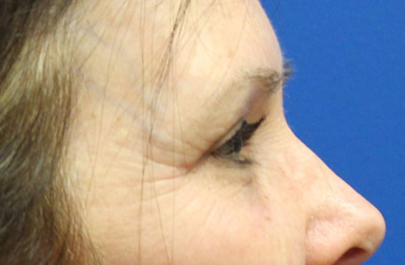 Upper Eyelid Surgery Before & After Gallery - Patient 413806 - Image 6