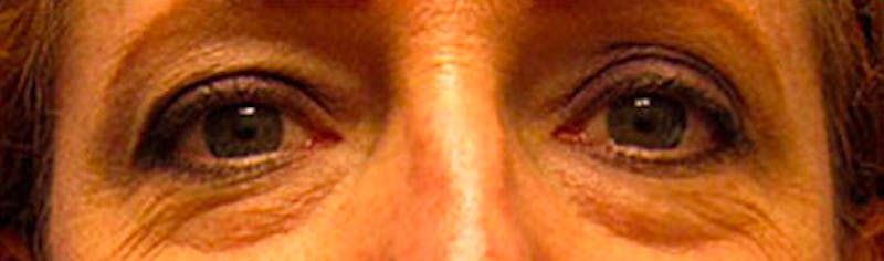 Upper Eyelid Surgery Before & After Gallery - Patient 268555 - Image 1