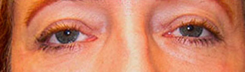 Upper Eyelid Surgery Before & After Gallery - Patient 268555 - Image 2