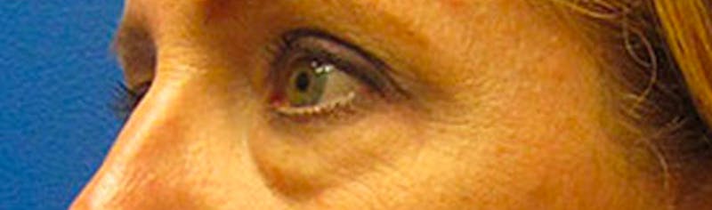 Upper Eyelid Surgery Before & After Gallery - Patient 268555 - Image 3