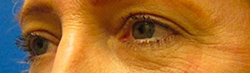 Upper Eyelid Surgery Before & After Gallery - Patient 268555 - Image 4