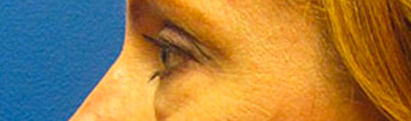 Upper Eyelid Surgery Before & After Gallery - Patient 268555 - Image 5